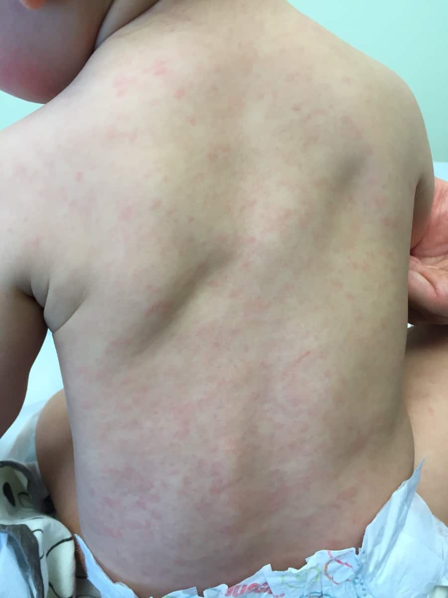 What Does The Roseola Rash Look Like 