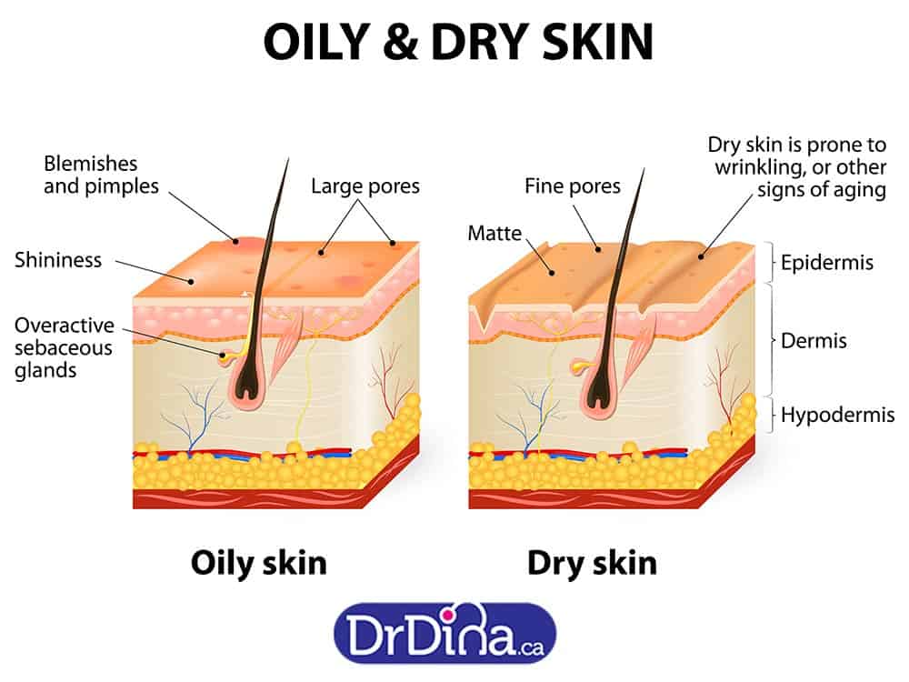 Dr Dina Kulik Baby Acne .. Different Types Of Acne And How ... back acne diagram 